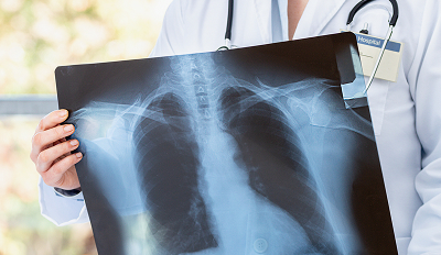 Healthcare provider holding up chest xray